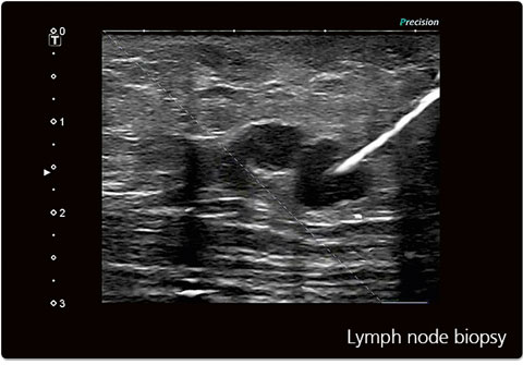 biopsie echo-guidée